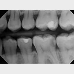 Intraorale rntgenoptagelser med firkantet tubus