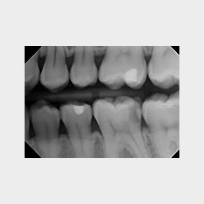 Intraorale rntgenoptagelser med firkantet tubus