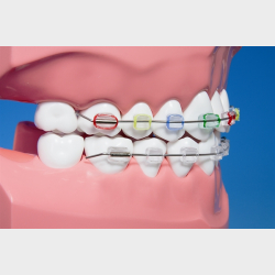Ortodontisk model til demonstration af tandbrstning inkl. tandbrste 