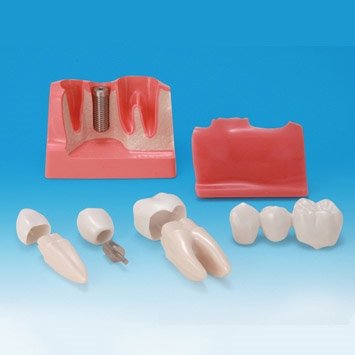 Maxi Implantat/Bro Studiemodel - Patientundervisning - Dentalinstituttet
