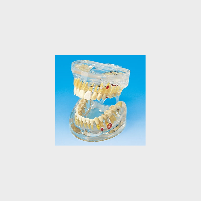 Transparent Disease Model - Patient education - Dentalinstituttet