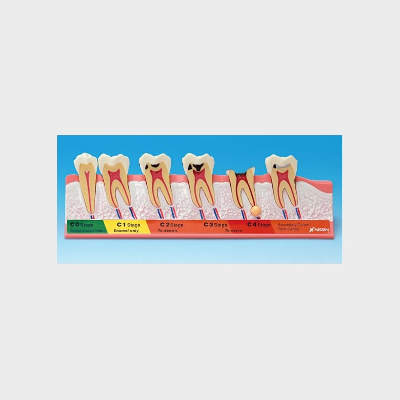 Dental model showing caries development