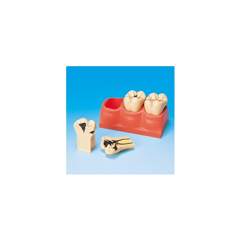 Stor Caries Studiemodel - Patientundervisning - Dentalinstituttet