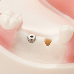 Basic Implantat Trningsmodel 