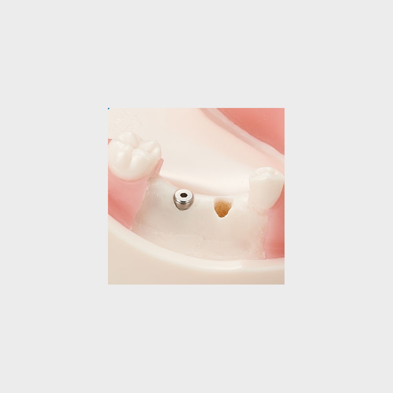 Basic Implantat Trningsmodel 